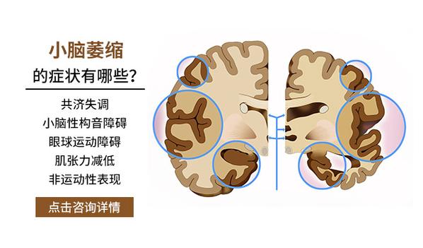 今晚澳门9点35分开什么生肖和送小脑萎缩儿子高考与小脑萎缩能上学吗